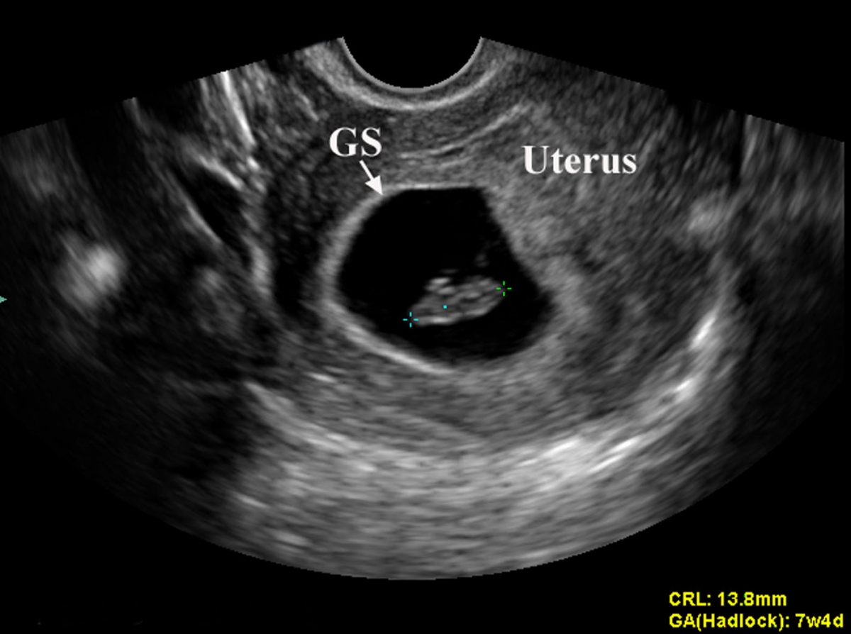 Fetal Parameters Obstetrics Medbullets Step 2/3
